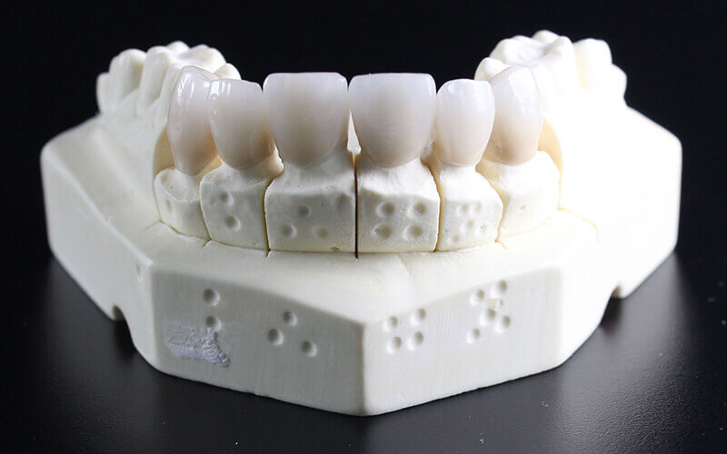 Corona dentale in zirconio ad alta resistenza posizionata su un modello dentale, evidenziando la sua capacità di abbinare il colore naturale dei denti circostanti per un aspetto estetico ottimale.