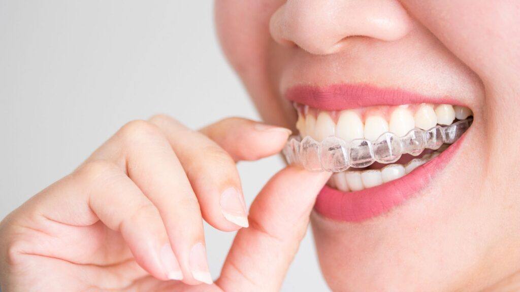 Cliente che si inserisce apparecchio invisalign